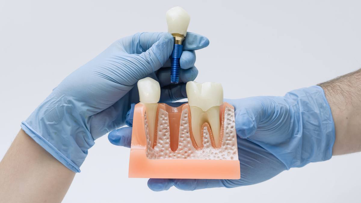 Blog Implantes