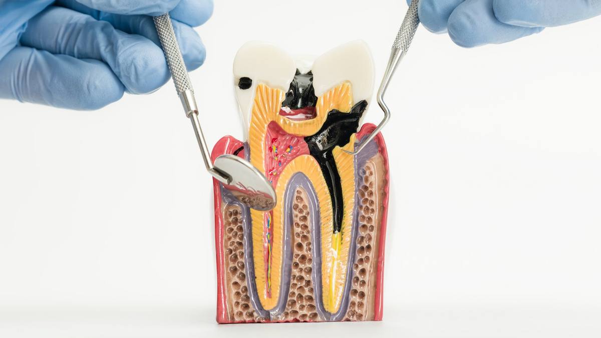 Endodoncia