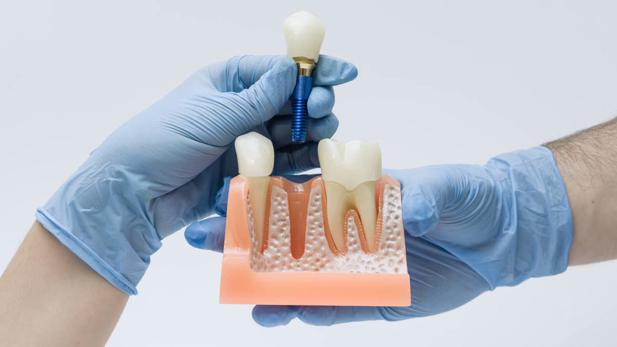 Implantes dentales